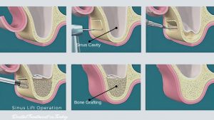  افزودن پودر پیوندی استخوان، برای پشتیبانی ایمپلنت دندان 