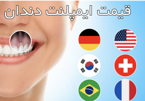 قیمت ایمپلنت کامل دندان